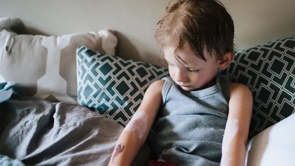 Can Calamine Lotion Be Used On Genital Area